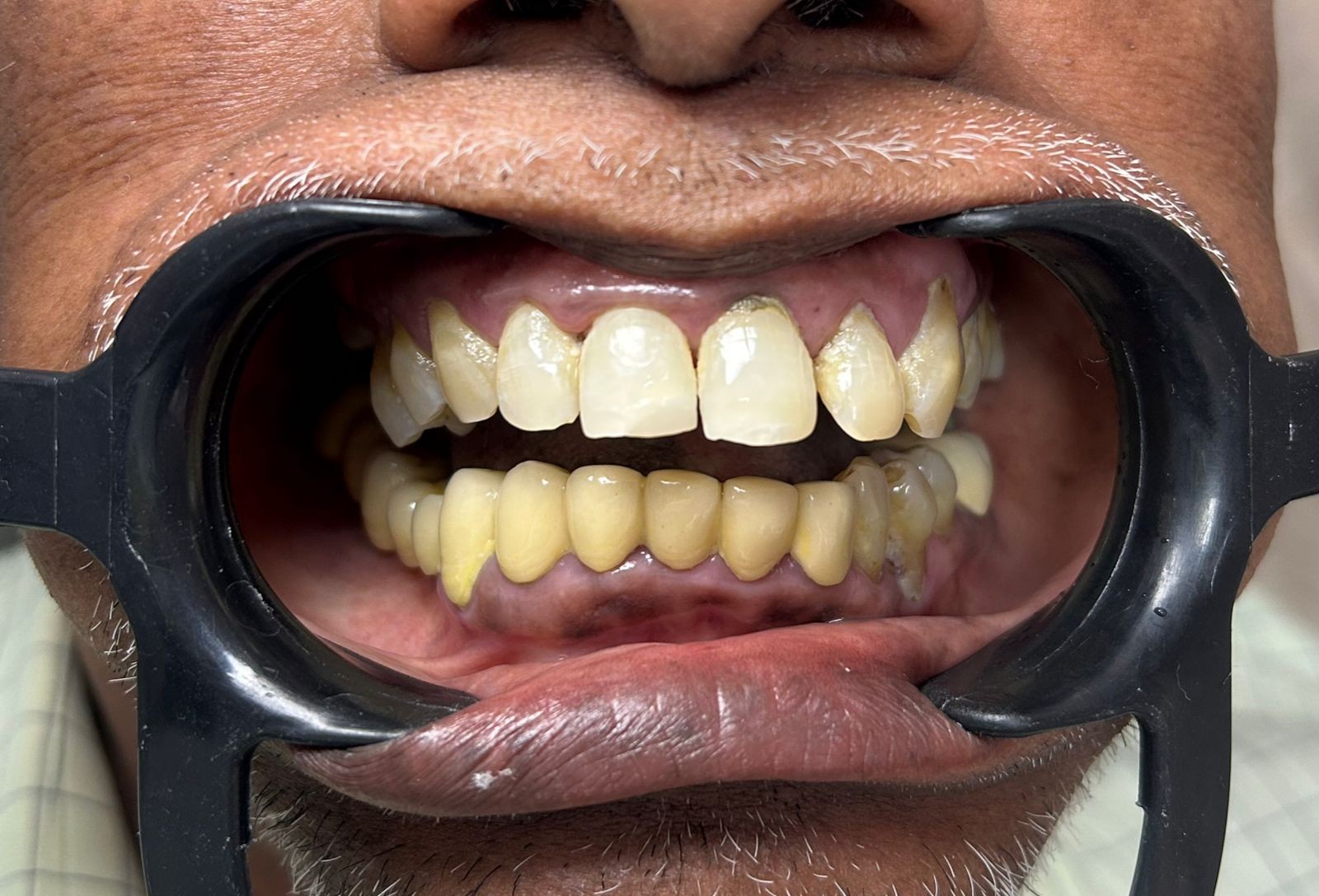 Before smile transformation 7